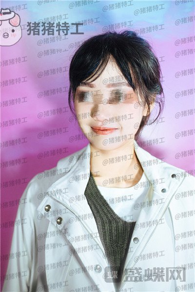 沈阳杏林朱石江下颌角磨骨案例价格分享,磨骨手术好像没有想象中的那么可怕~