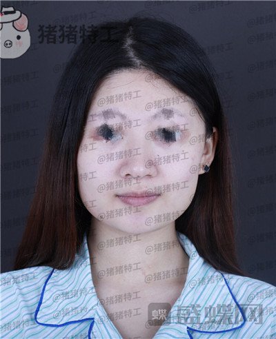 福州爱美尔黄振银隆鼻案例价格分享,没有精致的五官一个鼻子拯救了全部~