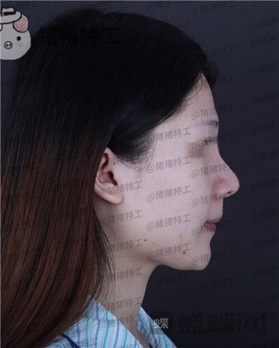 福州爱美尔黄振银隆鼻案例价格分享,没有精致的五官一个鼻子拯救了全部~