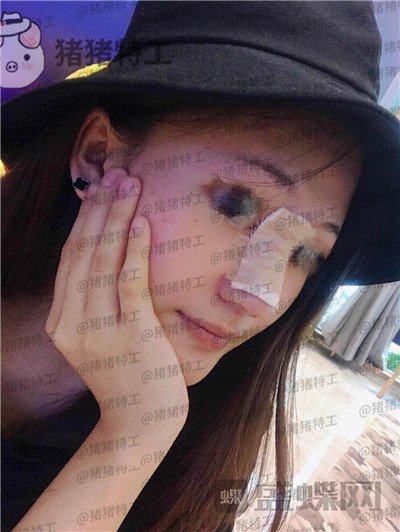 福州爱美尔黄振银隆鼻案例价格分享,没有精致的五官一个鼻子拯救了全部~