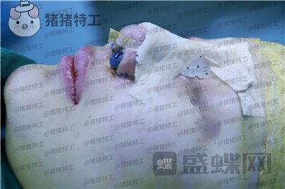 福州爱美尔黄振银隆鼻案例价格分享,没有精致的五官一个鼻子拯救了全部~