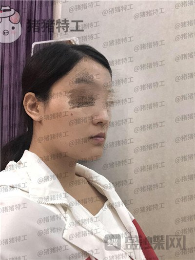 上海愉悦美联臣曹栋弼下颌角整形案例价格分享,脸突然变小这么多我还有点不习惯~