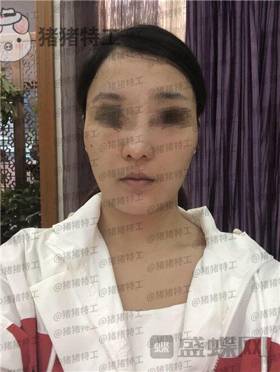 上海愉悦美联臣曹栋弼下颌角整形案例价格分享,脸突然变小这么多我还有点不习惯~