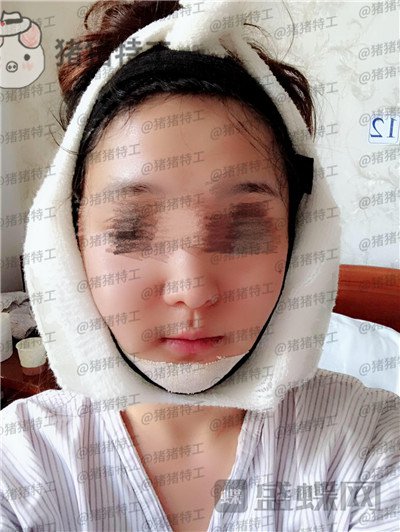 上海愉悦美联臣曹栋弼下颌角整形案例价格分享,脸突然变小这么多我还有点不习惯~