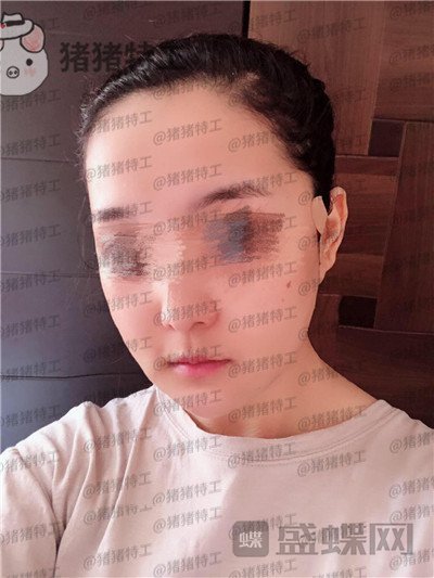 上海愉悦美联臣曹栋弼下颌角整形案例价格分享,脸突然变小这么多我还有点不习惯~