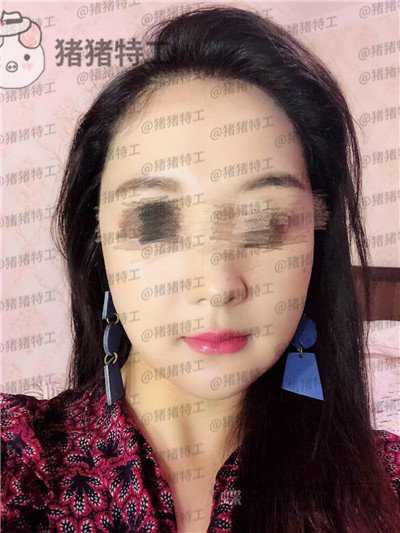 上海愉悦美联臣曹栋弼下颌角整形案例价格分享,脸突然变小这么多我还有点不习惯~