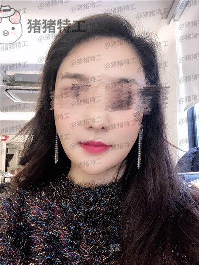 上海愉悦美联臣曹栋弼下颌角整形案例价格分享,脸突然变小这么多我还有点不习惯~