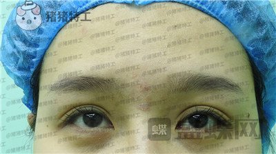 北京百达丽上海九院苏婷双眼皮修复案例价格分享,重获新生的眼睛电力十足~