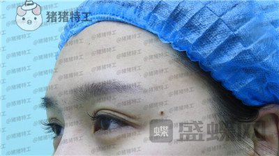 北京百达丽上海九院苏婷双眼皮修复案例价格分享,重获新生的眼睛电力十足~