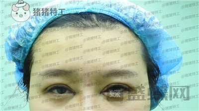 北京百达丽上海九院苏婷双眼皮修复案例价格分享,重获新生的眼睛电力十足~