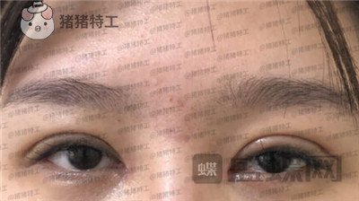 北京百达丽上海九院苏婷双眼皮修复案例价格分享,重获新生的眼睛电力十足~