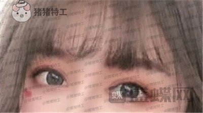北京百达丽上海九院苏婷双眼皮修复案例价格分享,重获新生的眼睛电力十足~