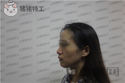 成都西区医院毛健清面部填充案例价格分享,做完像高中生这样年轻可爱的感觉真好~
