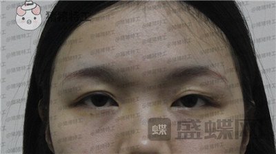 成都西区医院车红昌双眼皮案例价格分享,大转变亲妈都不认识的混血眼真的好喜欢~