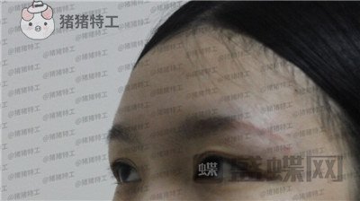 成都西区医院车红昌双眼皮案例价格分享,大转变亲妈都不认识的混血眼真的好喜欢~