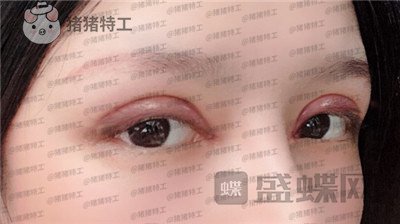 成都西区医院车红昌双眼皮案例价格分享,大转变亲妈都不认识的混血眼真的好喜欢~