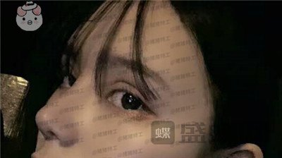 成都西区医院车红昌双眼皮案例价格分享,大转变亲妈都不认识的混血眼真的好喜欢~