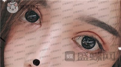 成都西区医院车红昌双眼皮案例价格分享,大转变亲妈都不认识的混血眼真的好喜欢~