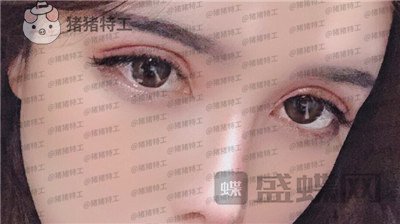 成都西区医院车红昌双眼皮案例价格分享,大转变亲妈都不认识的混血眼真的好喜欢~