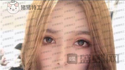 成都西区医院车红昌双眼皮案例价格分享,大转变亲妈都不认识的混血眼真的好喜欢~