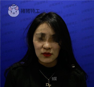北京壹加壹张绿峰面部填充案例价格分享,脸型确实比以前好看了许多~