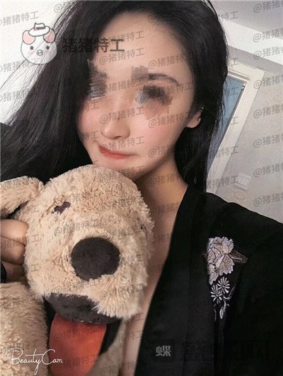 北京壹加壹张绿峰面部填充案例价格分享,脸型确实比以前好看了许多~