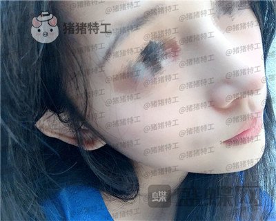 福州美贝尔赵栋材隆鼻案例价格分享,人生就像开了挂一样感谢我的高挺鼻梁~