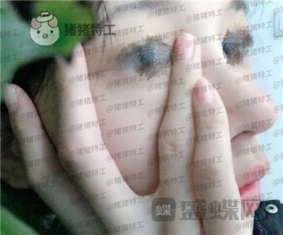 福州美贝尔赵栋材隆鼻案例价格分享,人生就像开了挂一样感谢我的高挺鼻梁~