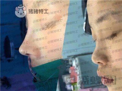 福州美贝尔赵栋材隆鼻案例价格分享,人生就像开了挂一样感谢我的高挺鼻梁~