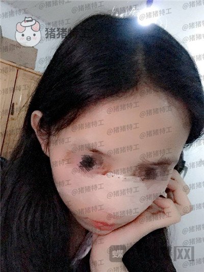 福州美贝尔赵栋材隆鼻案例价格分享,人生就像开了挂一样感谢我的高挺鼻梁~