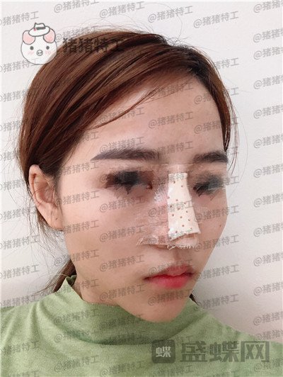 重庆当代王旭明鼻部手术案例价格分享,别人都说我现在看起来自信又美丽。