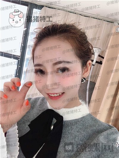 重庆当代王旭明鼻部手术案例价格分享,别人都说我现在看起来自信又美丽。
