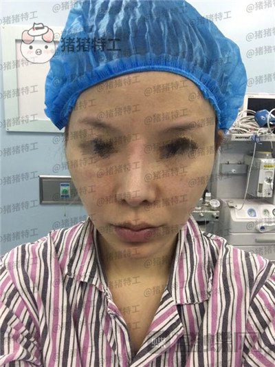 成都天使之翼尤军面部填充案例价格分享,朋友们都说我现在的脸更随和了~