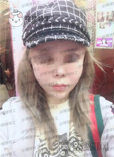 成都天使之翼尤军面部填充案例价格分享,朋友们都说我现在的脸更随和了~