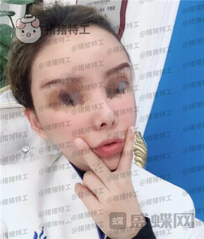成都天使之翼尤军面部填充案例价格分享,朋友们都说我现在的脸更随和了~