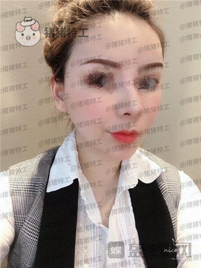 成都天使之翼尤军面部填充案例价格分享,朋友们都说我现在的脸更随和了~