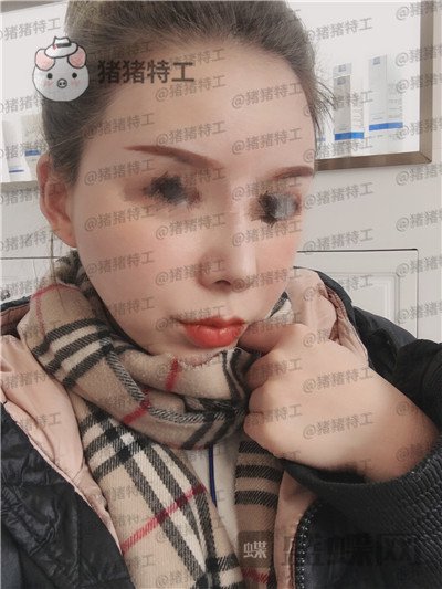 成都天使之翼尤军面部填充案例价格分享,朋友们都说我现在的脸更随和了~