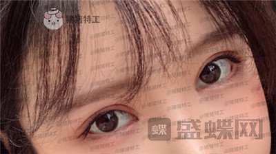 杭州伊琳毛琪双眼皮修复案例价格分享,这个妹子是iu本人吗目光神似~