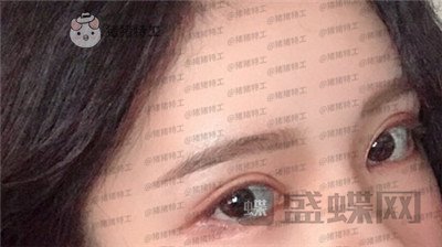 杭州伊琳毛琪双眼皮修复案例价格分享,这个妹子是iu本人吗目光神似~