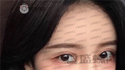 杭州伊琳毛琪双眼皮修复案例价格分享,这个妹子是iu本人吗目光神似~