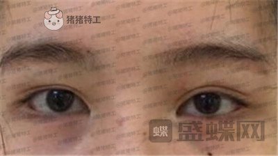 杭州伊琳毛琪双眼皮修复案例价格分享,这个妹子是iu本人吗目光神似~
