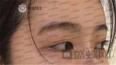 杭州伊琳毛琪双眼皮修复案例价格分享,这个妹子是iu本人吗目光神似~