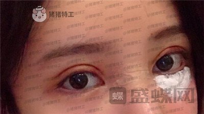 杭州伊琳毛琪双眼皮修复案例价格分享,这个妹子是iu本人吗目光神似~