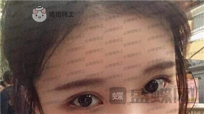 杭州伊琳毛琪双眼皮修复案例价格分享,这个妹子是iu本人吗目光神似~