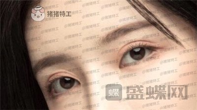 杭州伊琳毛琪双眼皮修复案例价格分享,这个妹子是iu本人吗目光神似~
