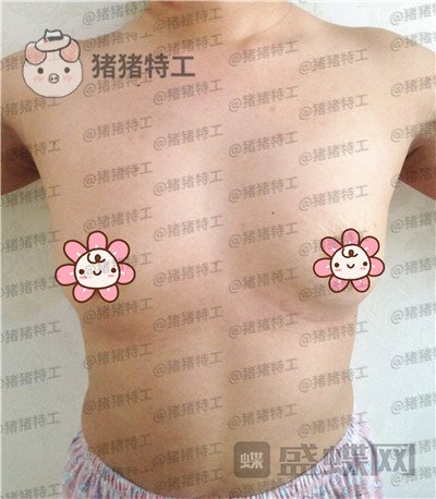 沧州华美白伟枫隆胸案例价格分享,所谓晃动的美丽就是这种果~