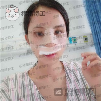 长沙美莱斌鼻部手术案例价格分享,存了好久的钱换来这个鼻子大家帮我看看~