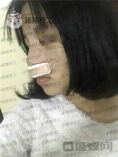 重庆军美曾令宇隆鼻案例价格分享,刚做完鼻子千万不能感冒哦~