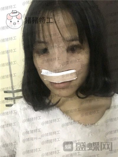 重庆军美曾令宇隆鼻案例价格分享,刚做完鼻子千万不能感冒哦~