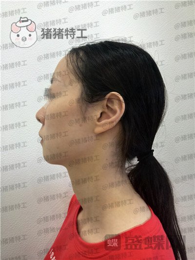 南京美贝尔黄名斗面部填充案例价格分享,填完整个皮肤光泽度惊人~